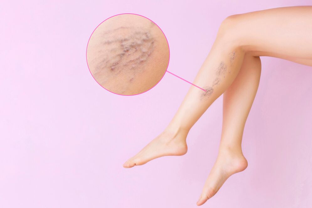 symptoms of varicose veins on the legs