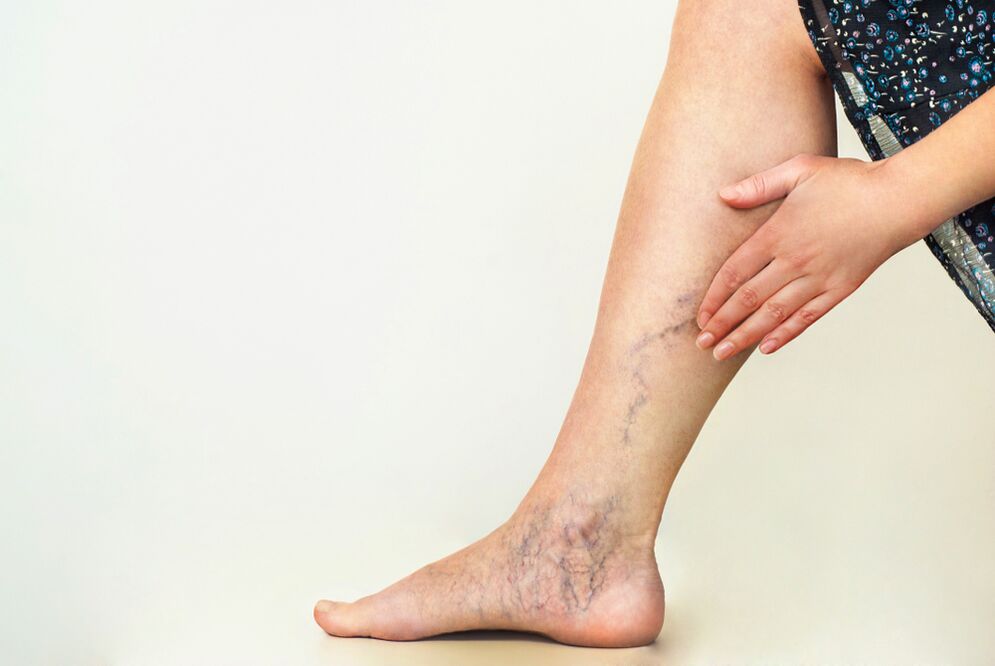 vascular pathology of varicose veins