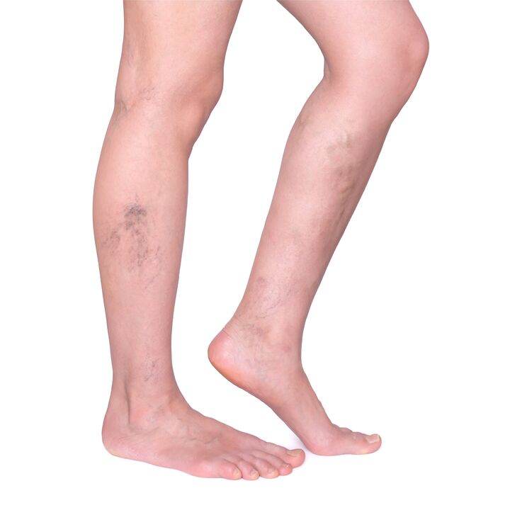 indications for Neoveris - swollen, tortuous veins in the legs